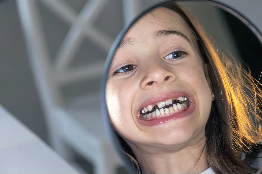 Broken Tooth Repair