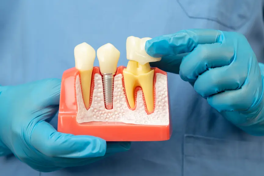 Dental Crowns