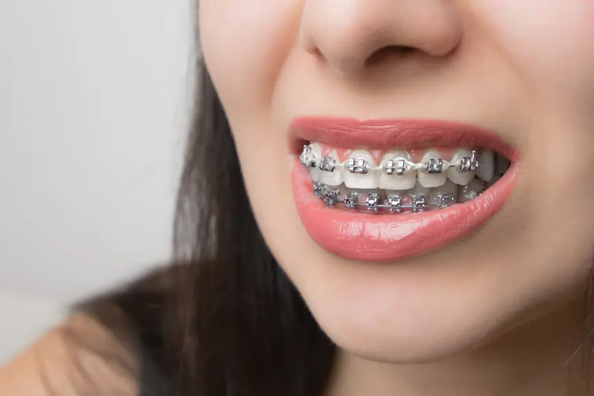 Clear Braces in Grimsby