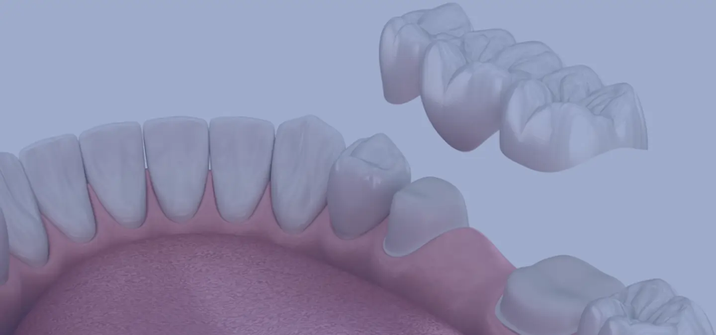 Dental Bridges in Grimsby