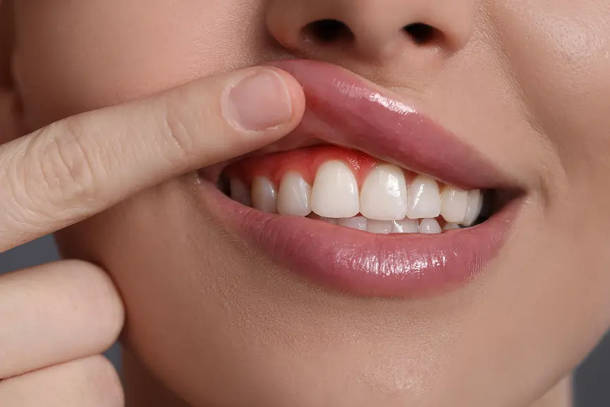 Gum Contouringin Grimsby
