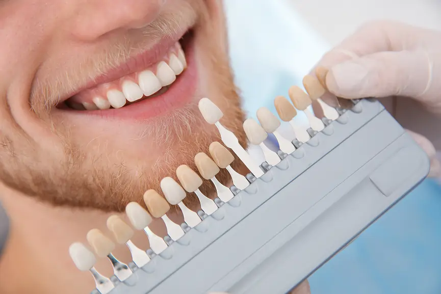 Veneers in Grimsby