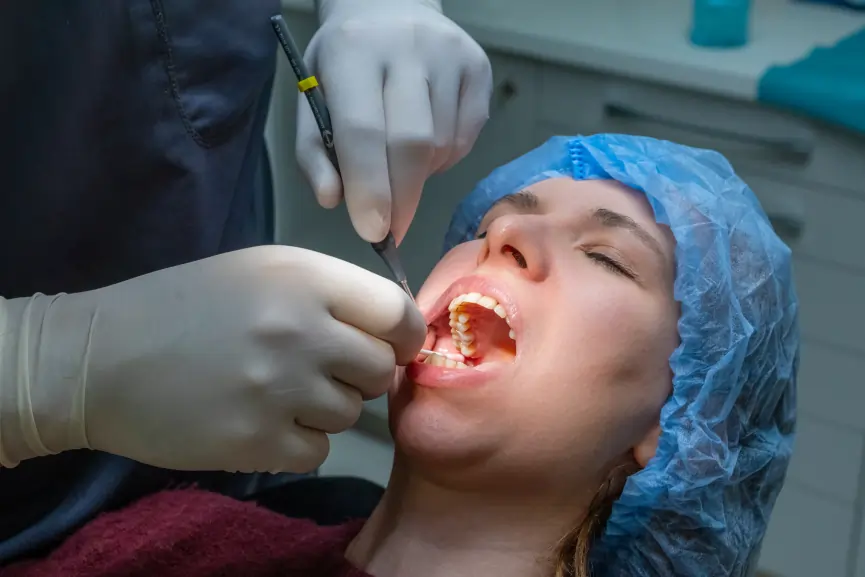 Wisdom Teeth Removalin Grimsby