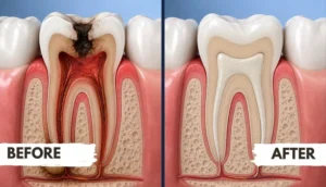Before and After Root Canal