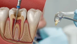 Extract Tooth vs Root Canal